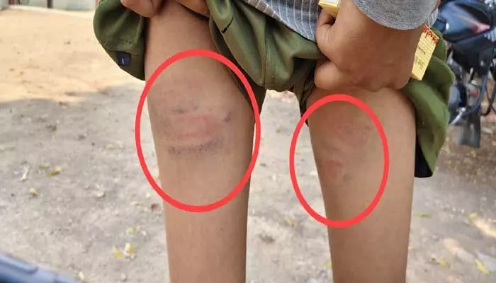 గద్వాల జిల్లా గురుకుల విద్యార్థులను చితకబాదిన ప్రిన్సిపల్