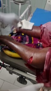 భార్య కాలును నరికిన భర్త