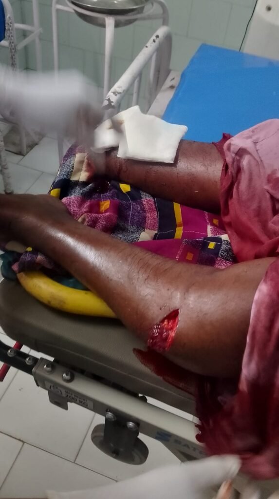 భార్య కాలును నరికిన భర్త