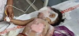 మదనపల్లిలో బాలుడికి కాఫీ పడడంతో గాయాలు