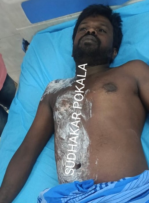 ఉపాధి పనుల్లో పిడుగుపాటు.. కూలీకి తీవ్ర గాయాలు