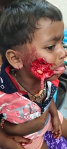 కుక్క దాడి తీవ్రంగా గాయపడినచిన్నారి